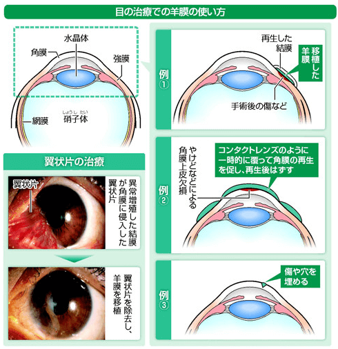 羊膜で目(角膜)の治療手術1